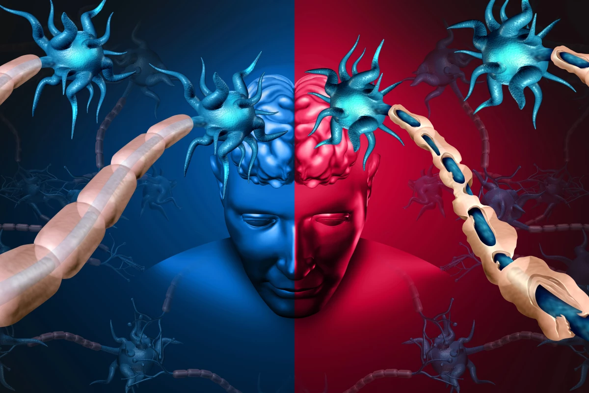 The findings indicate MS could have two distinct degenerative pathways, one fast and the other slow. And this knowledge could help better inform patients and doctors.