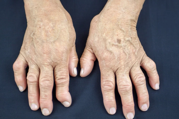 A new study in mice has shown promise in preventing arthritis