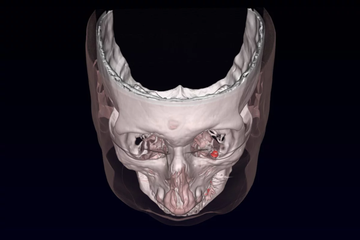 The magnetic prosthesis (shown in red) are implanted to reduce uncontrollable eye movements associated with the condition nystagmus