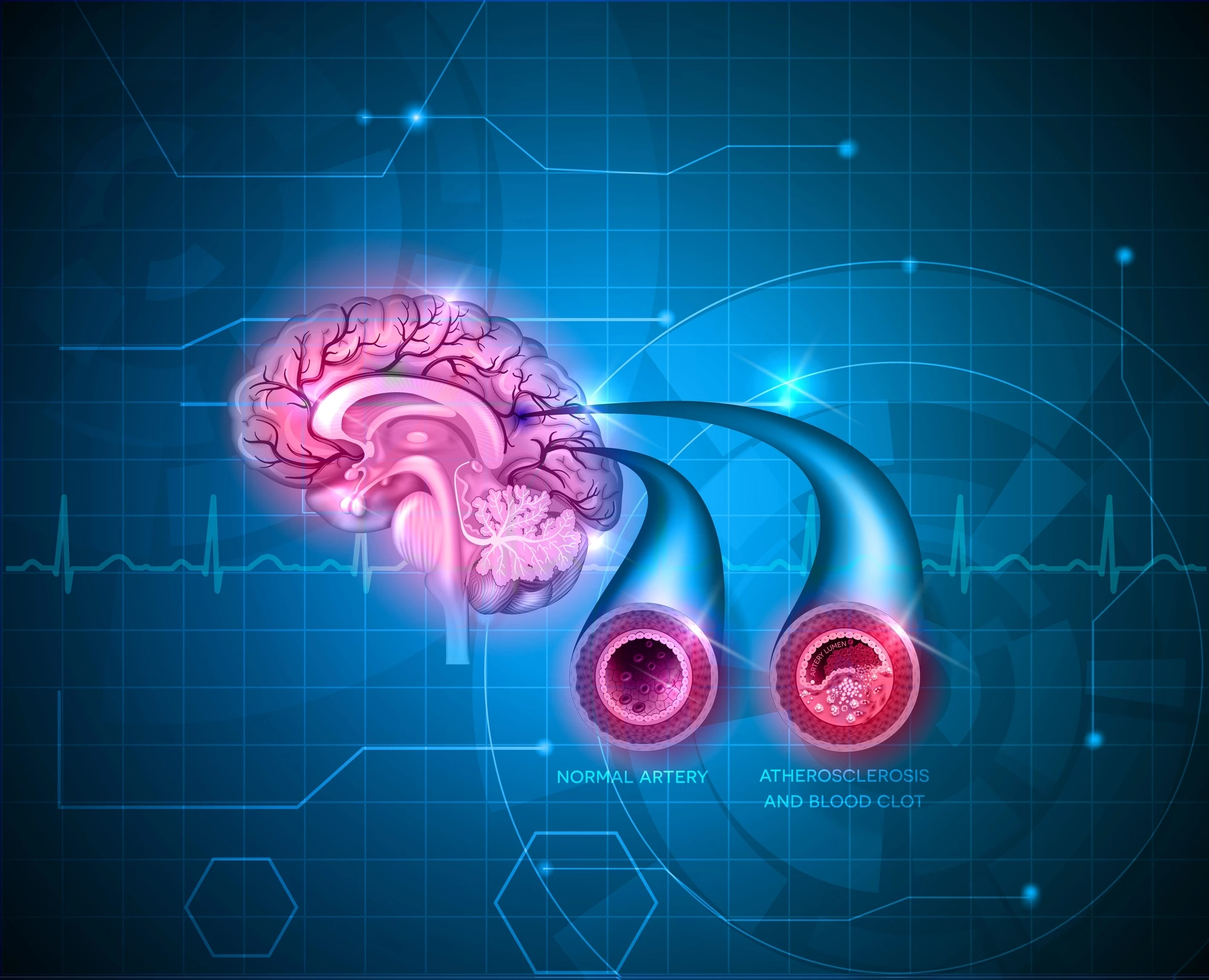 New research paves the way for a blood test that can detect whether someone has suffered a minor stroke