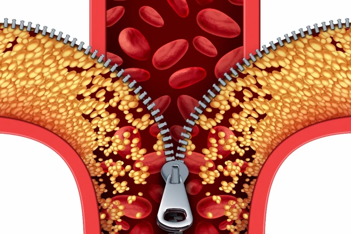Scientists have discovered that a cancer drug can also combat fatty arteries by reducing inflammation and mimicking exercise
