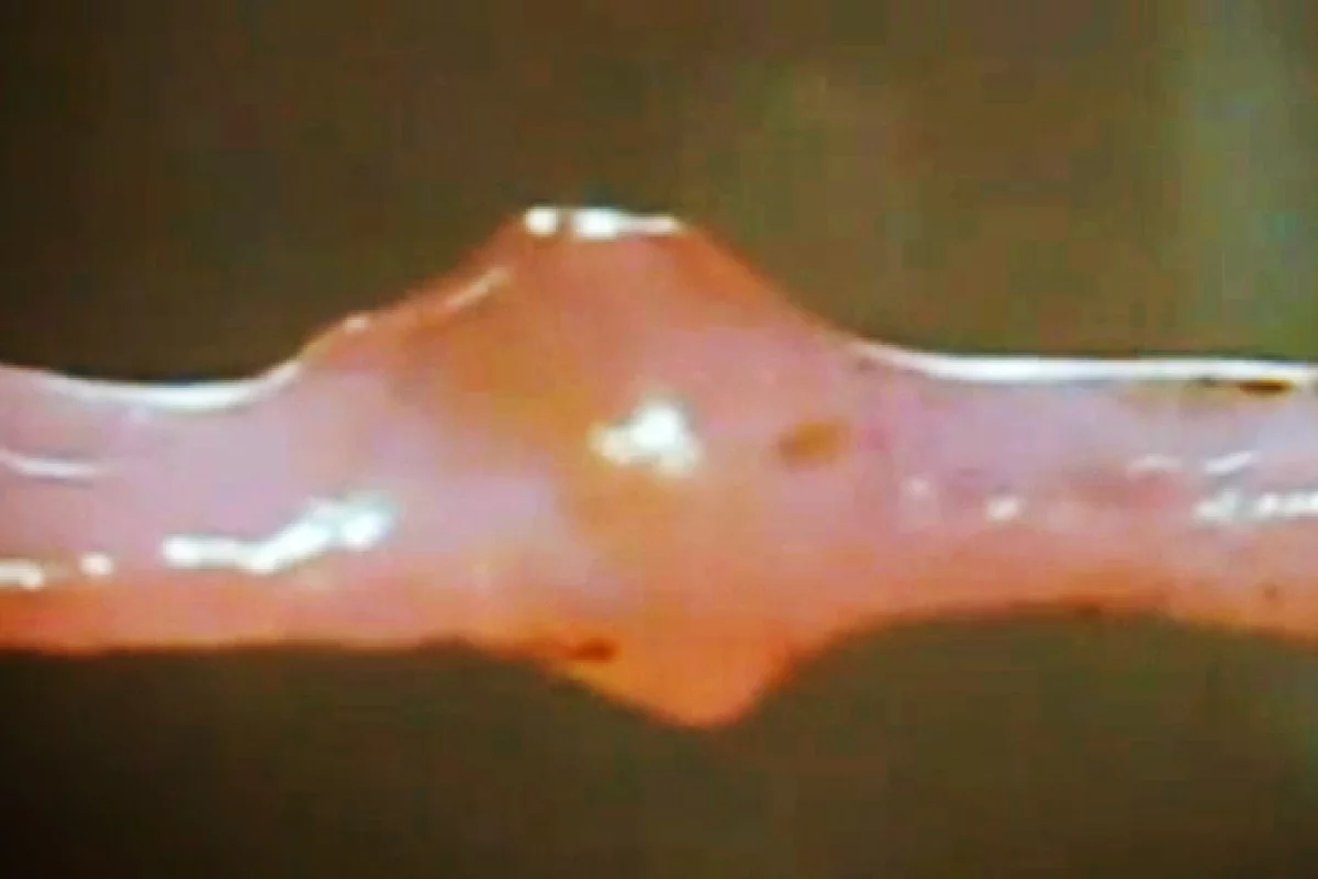 The mini heart takes the form of a cuff of cardiac tissue, wrapped around a vein