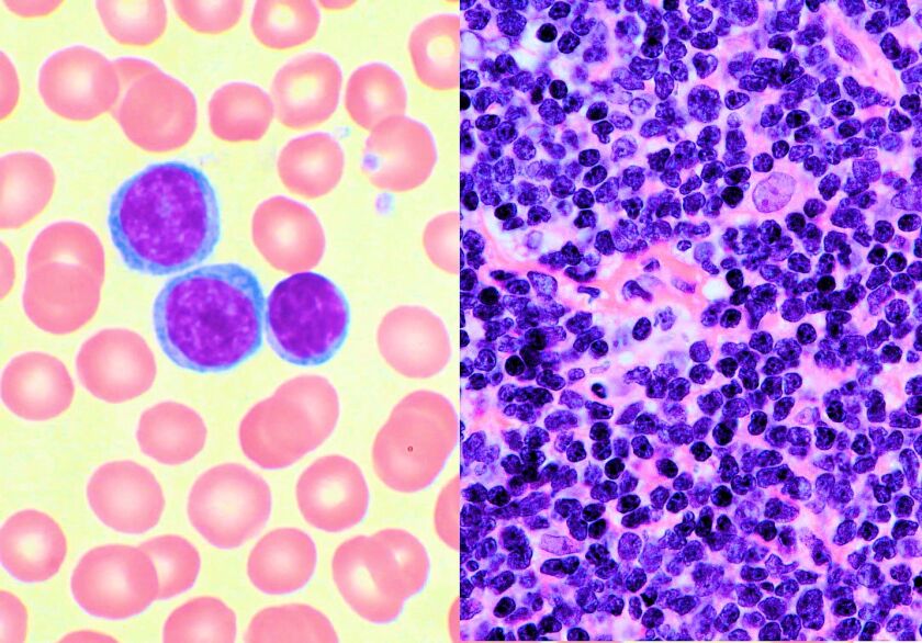 A pair of high power micrographs of blood cancers (left) chronic lymphocytic leukemia - dark nuclei with little cytoplasm (right) mantle cell tumor - lymphoma cells have irregular boundaries (Photos: Mary Ann Thompson and Gabriel Caponetti, MD, both via Wikimedia Commons)