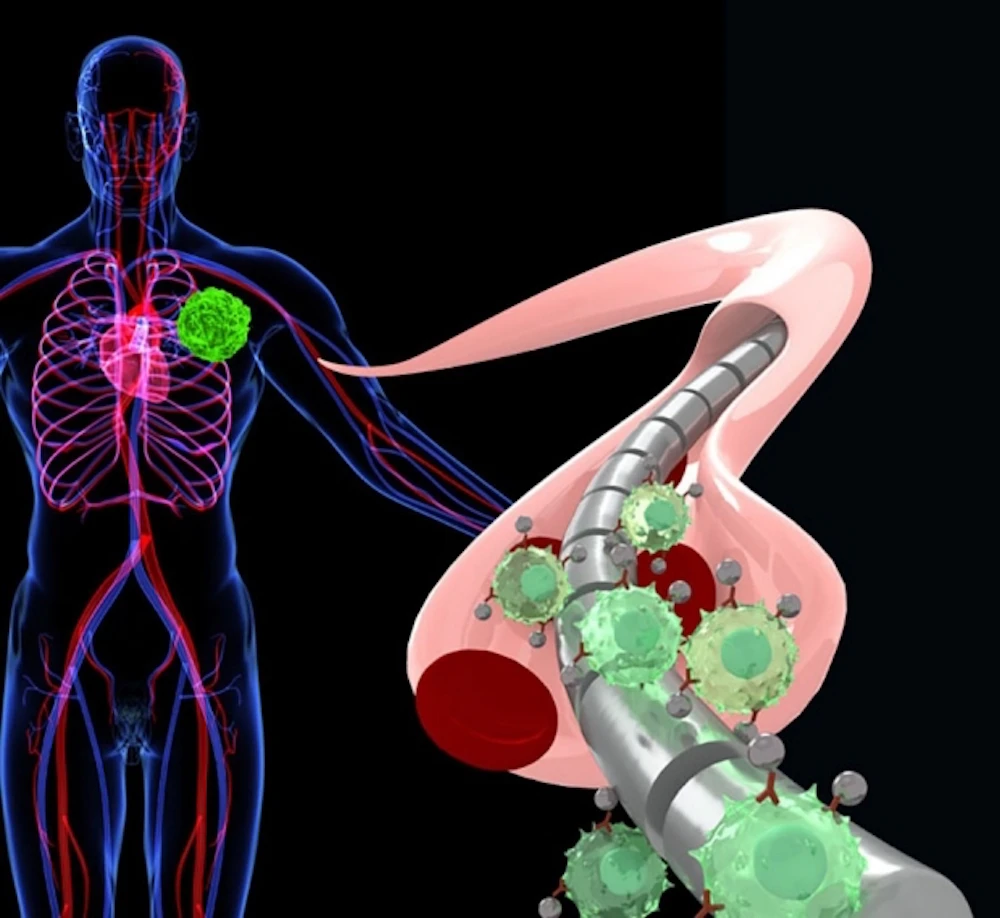 A magnetic wire attracts free-floating tumor cells that have been magnetized by specially engineered nanoparticles
