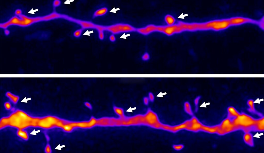 The image above shows spine-synapse density in the medial prefrontal cortex before (top) and after NV-5138 treatment (bottom).