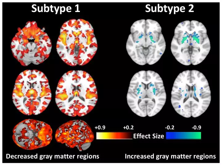 Sixty percent of the subjects were found to show decreased gray matter as predicted but a startling 40 percent of subjects displayed virtually normal brains defying common neuroanatomical notions of schizophrenia