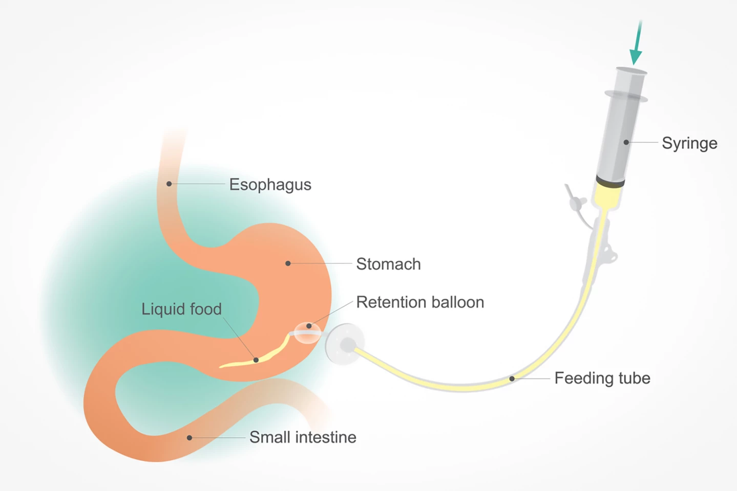 How a PEG feeding tube is inserted directly