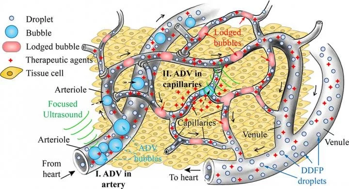 A diagram showing how gas embolotherapy works to kill tumors