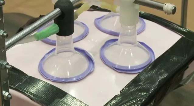 The R-Aide is designed to lift up obese patients' abdominal fat during surgery, allowing them to breathe more easily