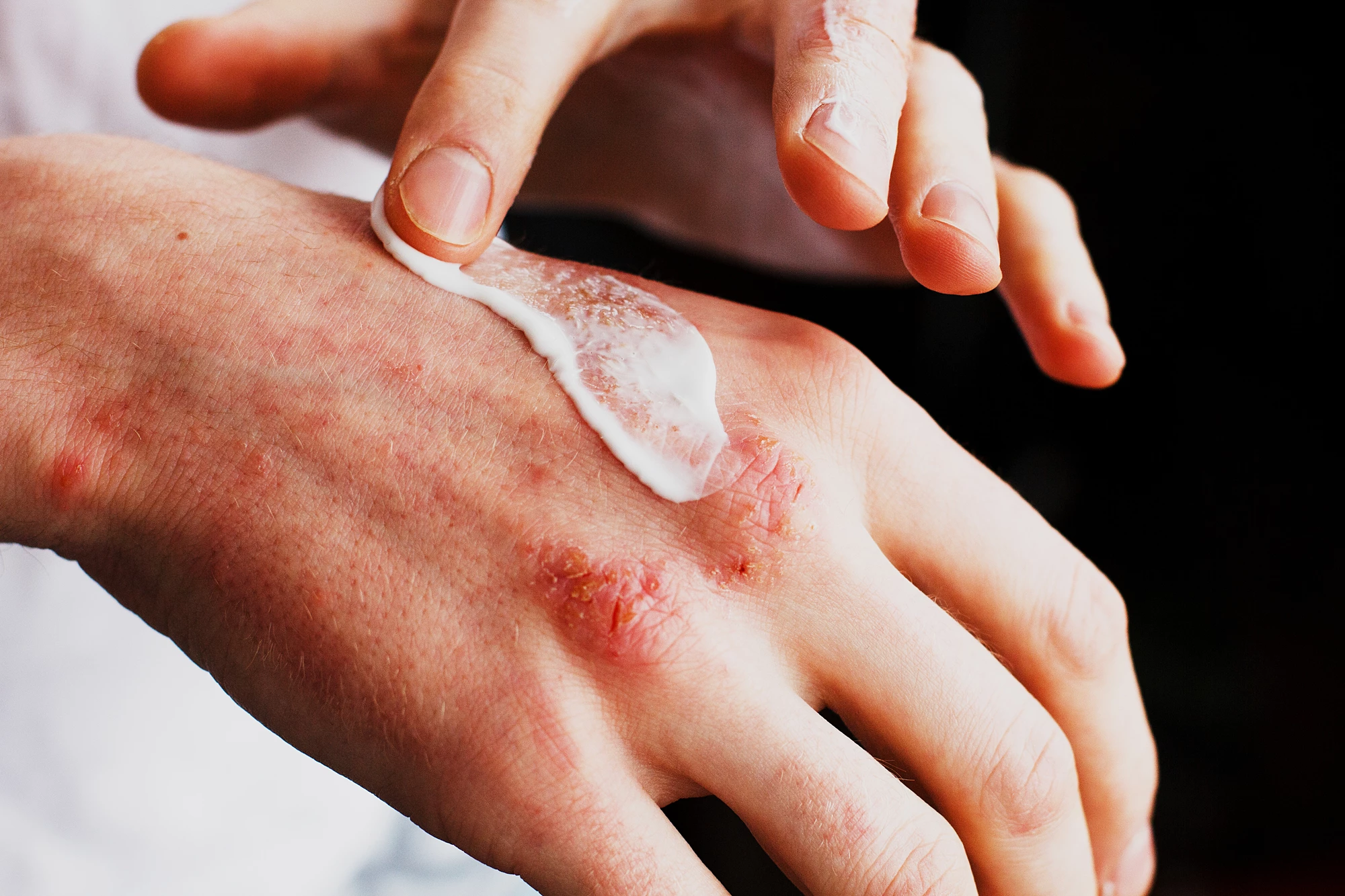 Researchers have assessed the effectiveness of available eczema treatments