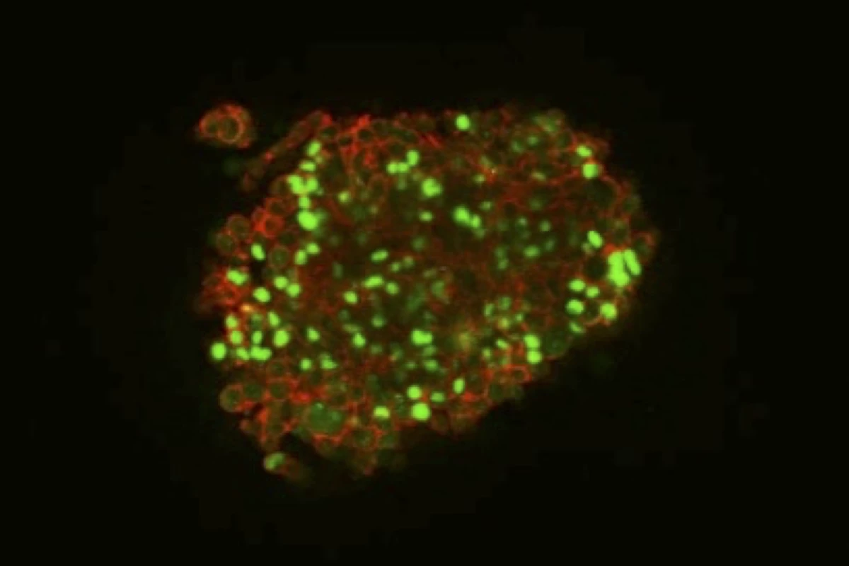 Human brain cancer cells cultured on a newly created DN gel exhibited protein markers of stem cells (green)