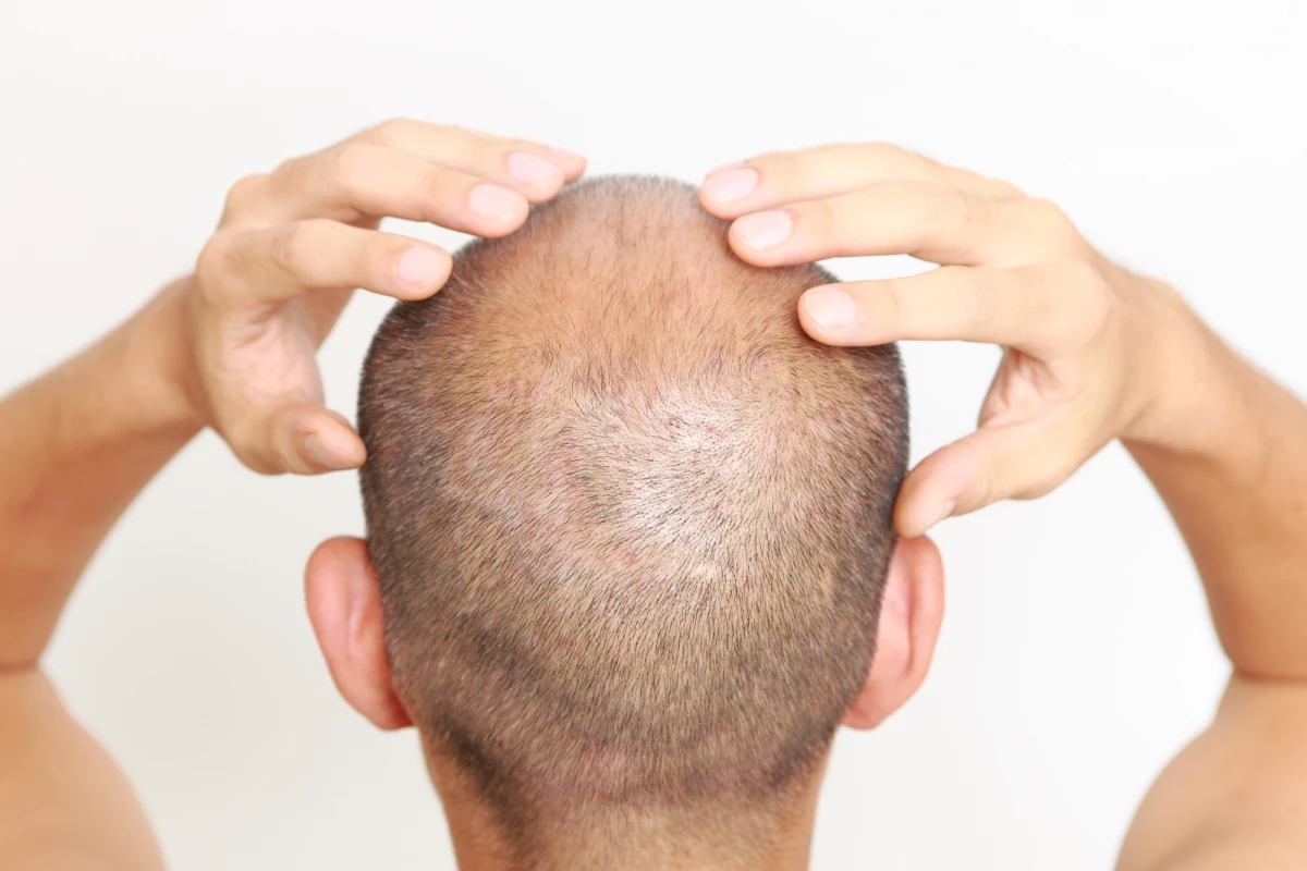 Scientists have made a key discovery around hair loss