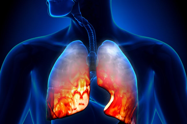 Scientists from the University at Buffalo and New York University's Langone Medical Center have developed a new vaccine that targets pneumococcal disease