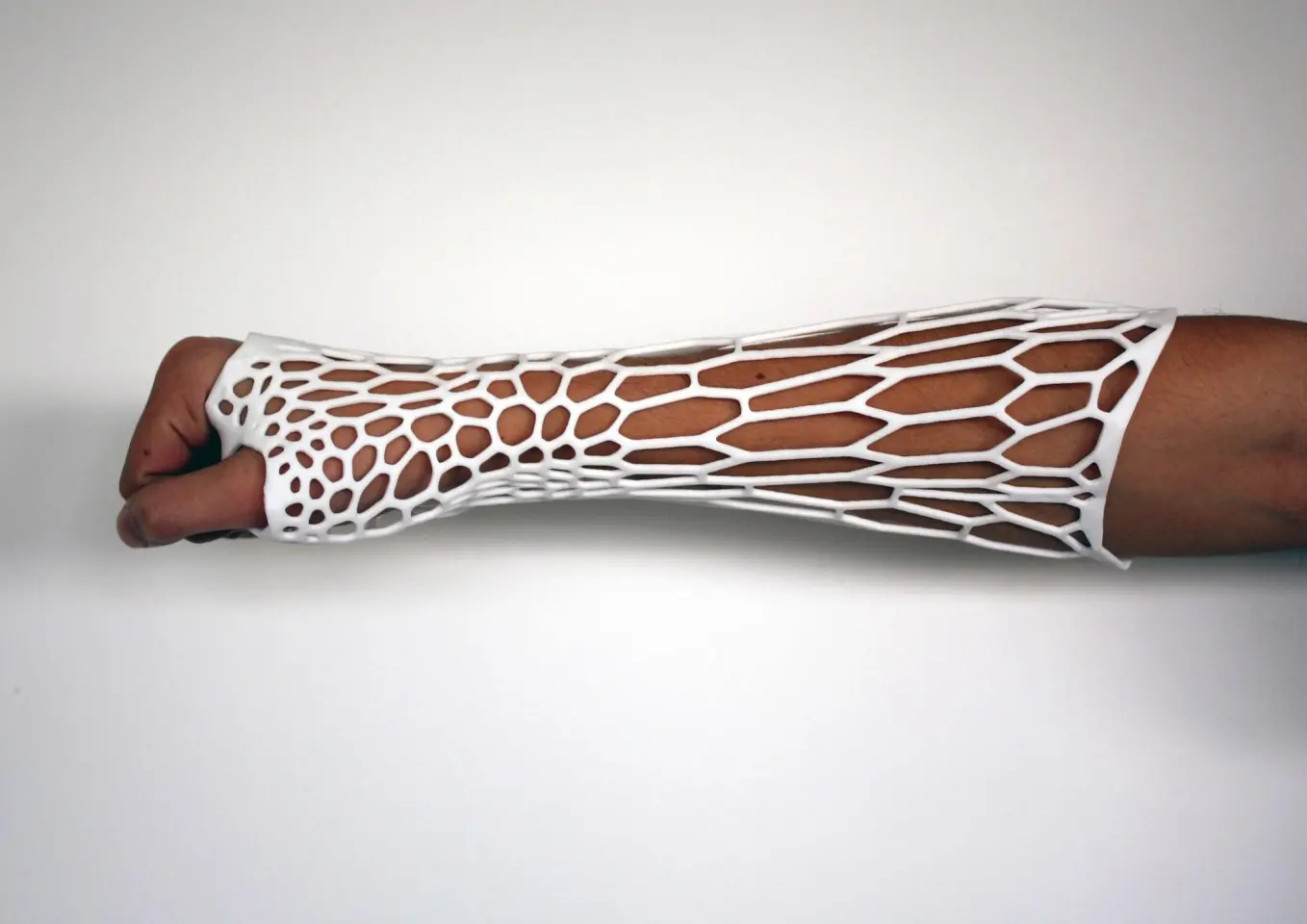 The Cortex Fracture Support system