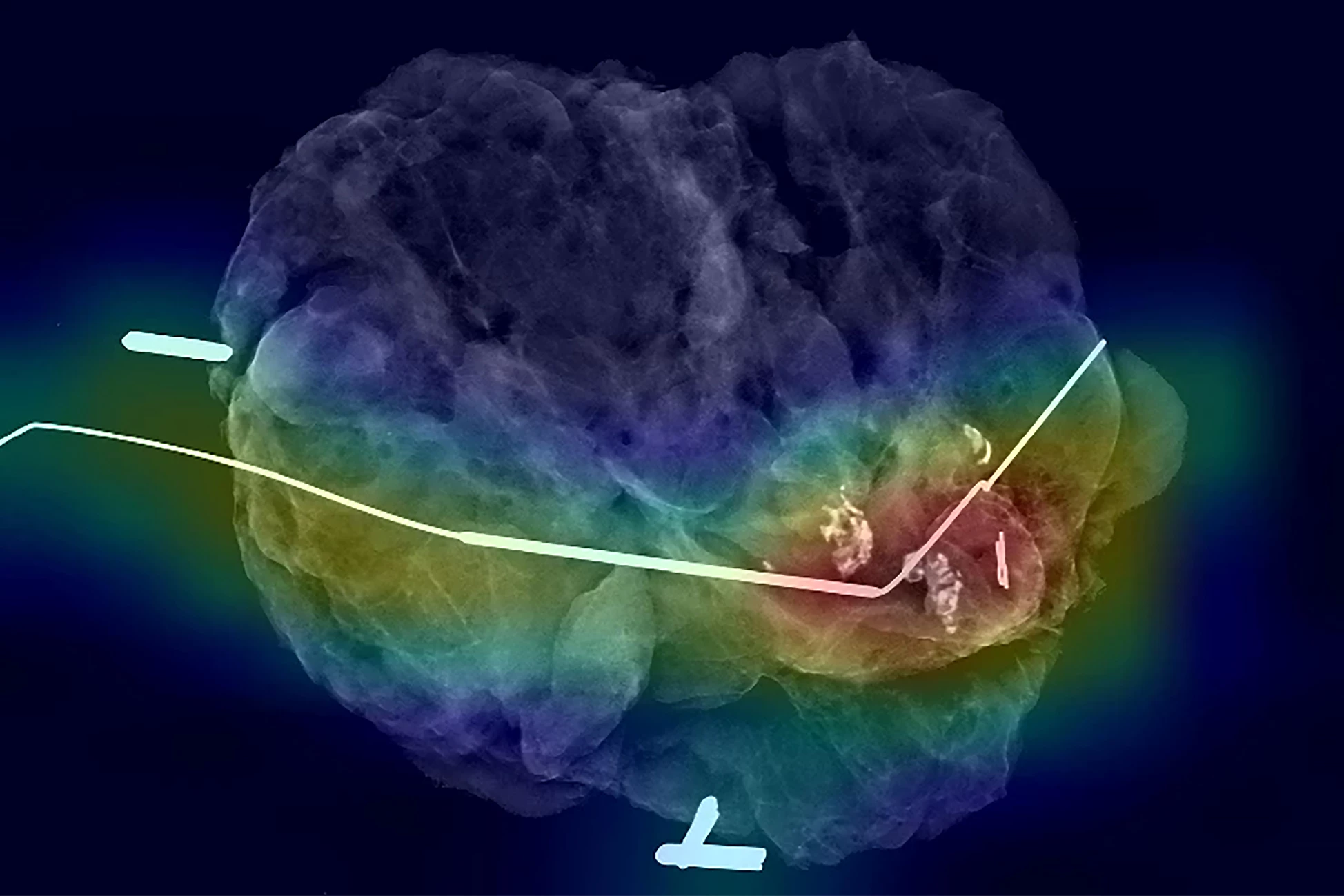 Researchers have taught an AI model to predict whether surgeons have removed all cancerous tissue during breast cancer surgery