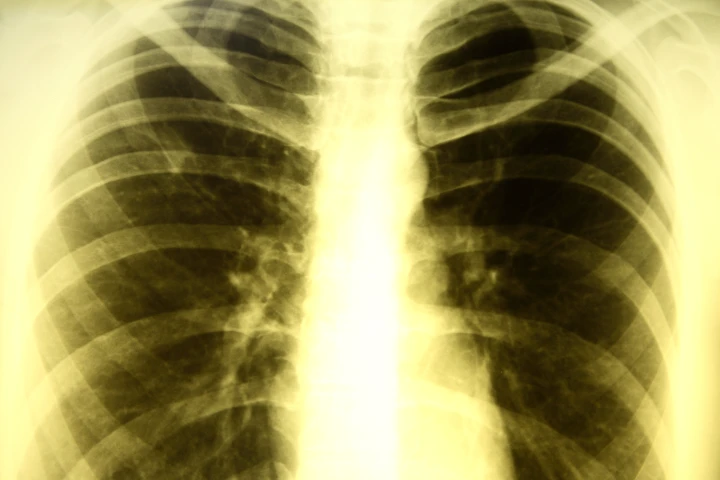 A team of international researchers has turned to stem cells in a quest to find an a more effective treatment for patients with resistant tuberculosis (Image: Shutterstock)