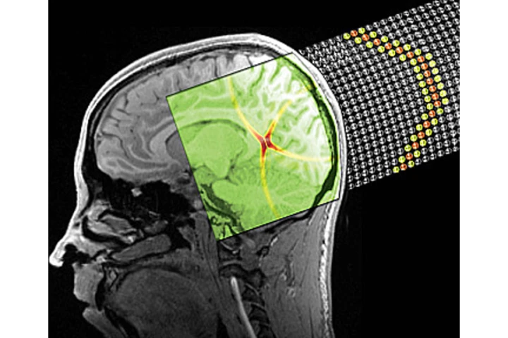 A stylized image depicting a sound bullet superposed onto a brain MRI (Image: Spadoni & Daraio/Caltech)