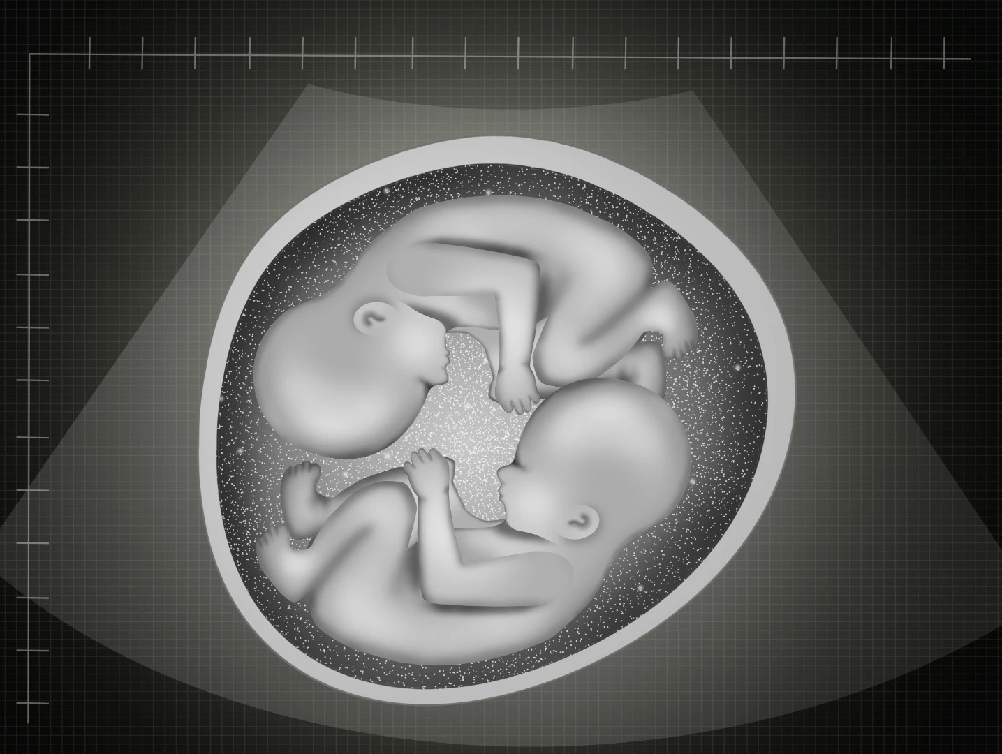 Semi-identical twins born in Australia mark only the second known case in the world