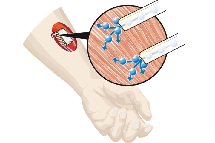 The new chemical chip can control the delivery of the neurotransmitter acetylcholine, enabling the chemical control of muscles in cases where the signaling system may not work for some reason