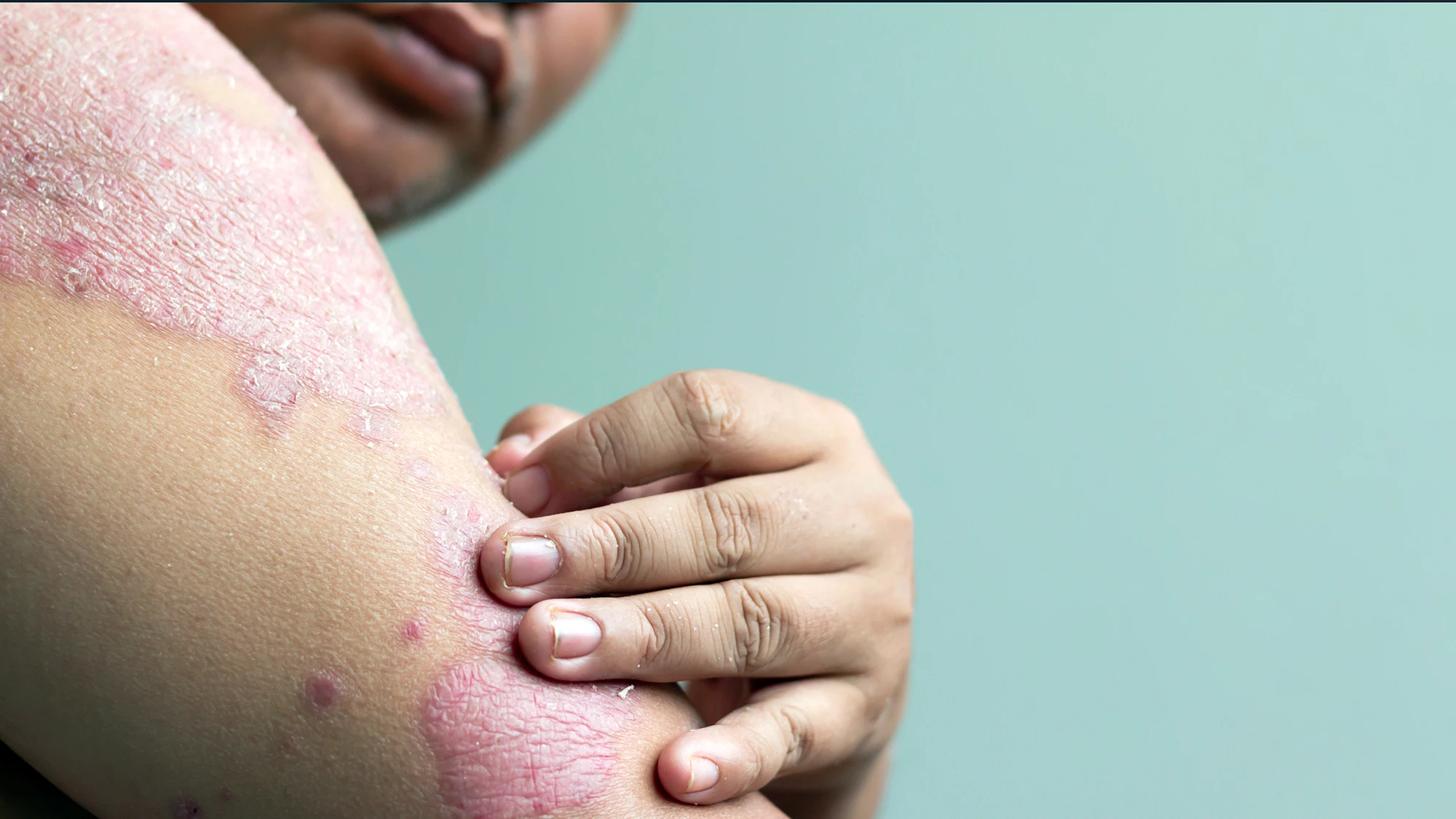 One topical foam effectively treats psoriasis in two places: the body and the scalp