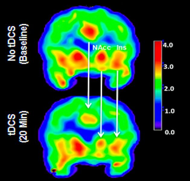 PET scan of a patient's brain before and after tDCS stimulation with red and yellow showing regions with large numbers of available mu-opioid receptors