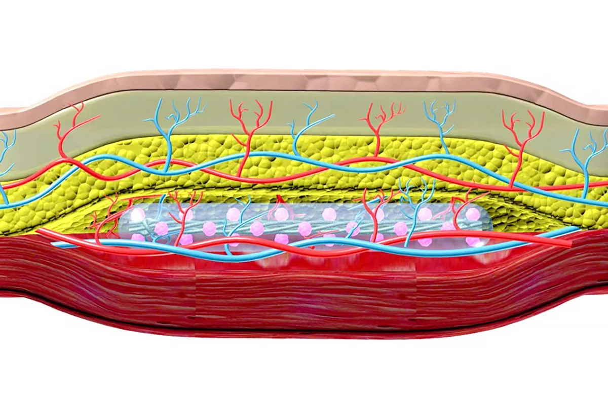Researchers implanted a thread-like device under the skin that secretes insulin via islet cells (pink balls) while receiving nutrients and oxygen from blood vessels