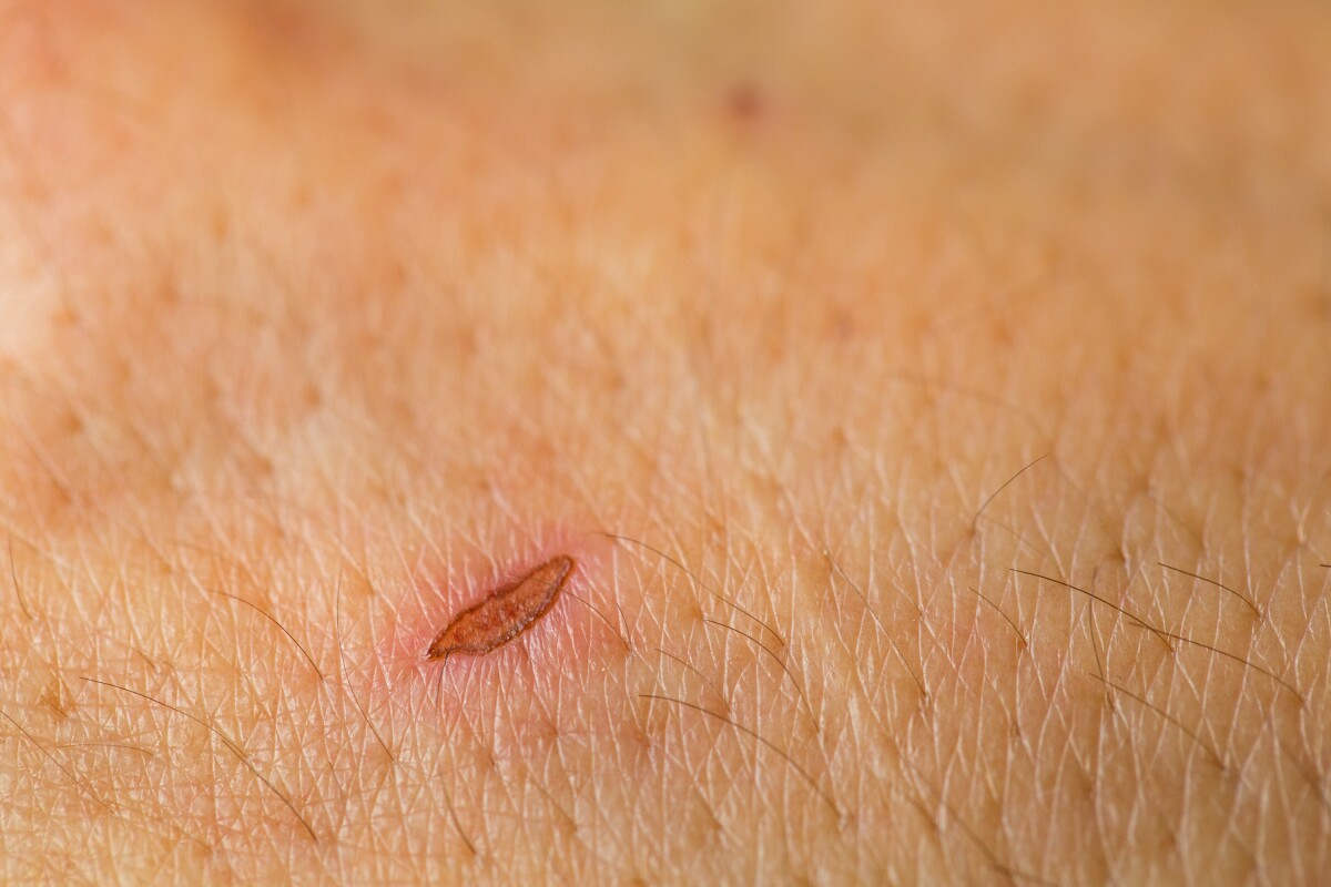 A material currently in development works in the same fashion as a scab, to accelerate the healing of wounds (Photo: Shutterstock)