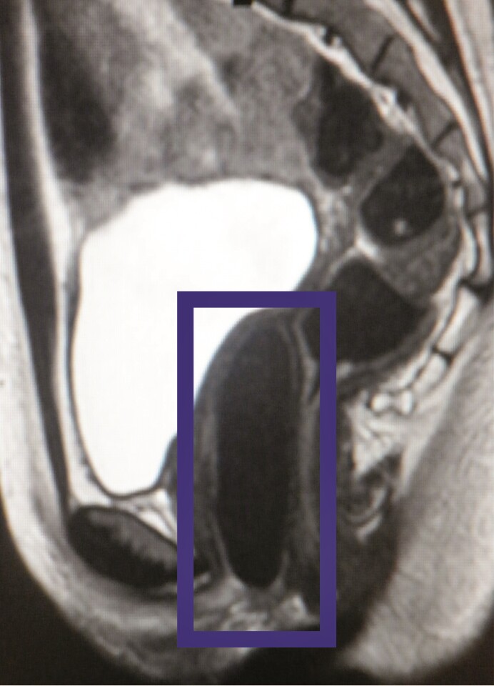 An MRI showing one of the lab-engineered vaginas in place