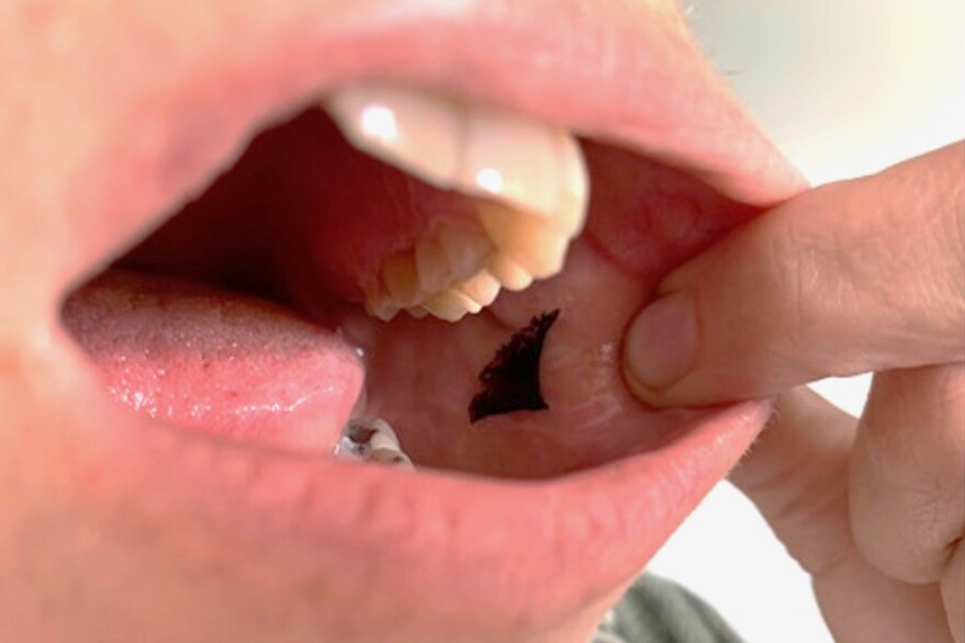 A placebo version of the patch, on the inside of a test subject's cheek