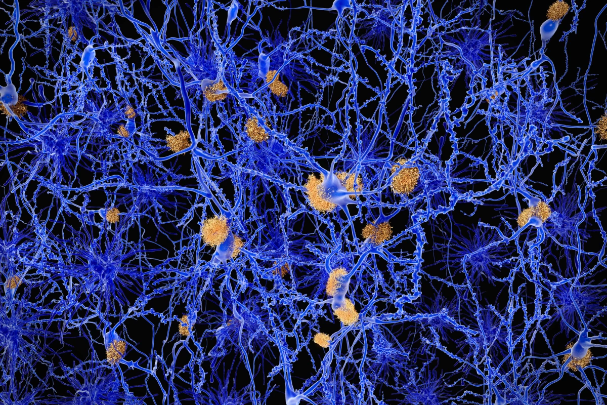 An ongoing long-term trial suggests high levels of amyloid proteins in the brain do serve as an early sign of Alzheimer's disease before cognitive decline becomes apparent