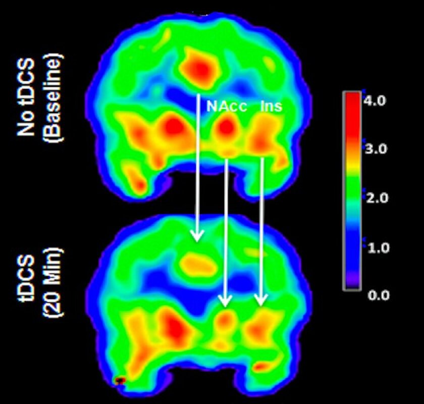 PET scan of a patient's brain before and after tDCS stimulation with red and yellow showing regions with large numbers of available mu-opioid receptors