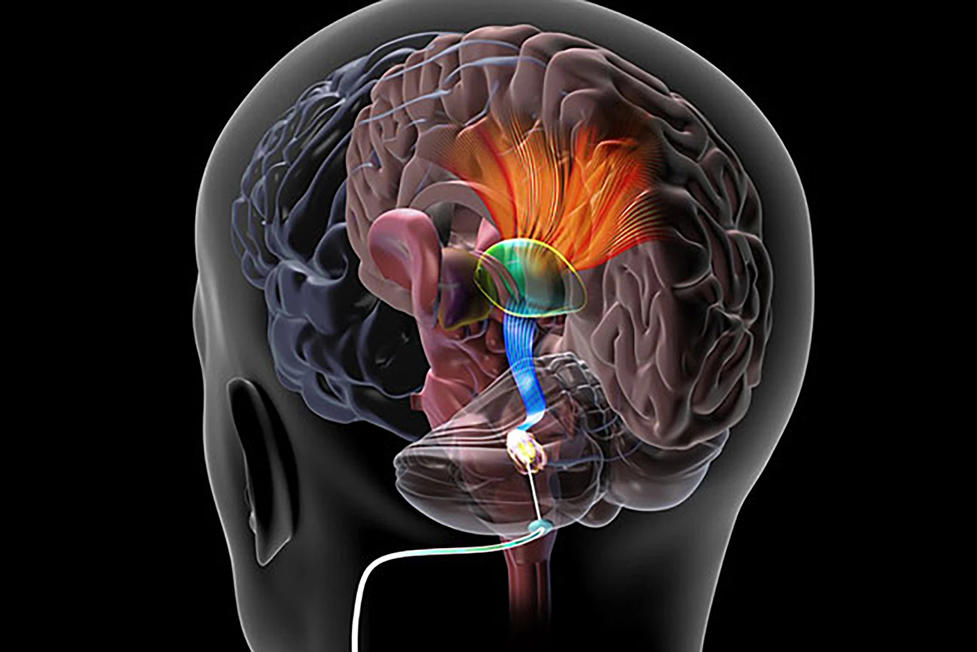 A study has found that deep brain stimulation paired with physical therapy assists with post-stroke rehabilitation