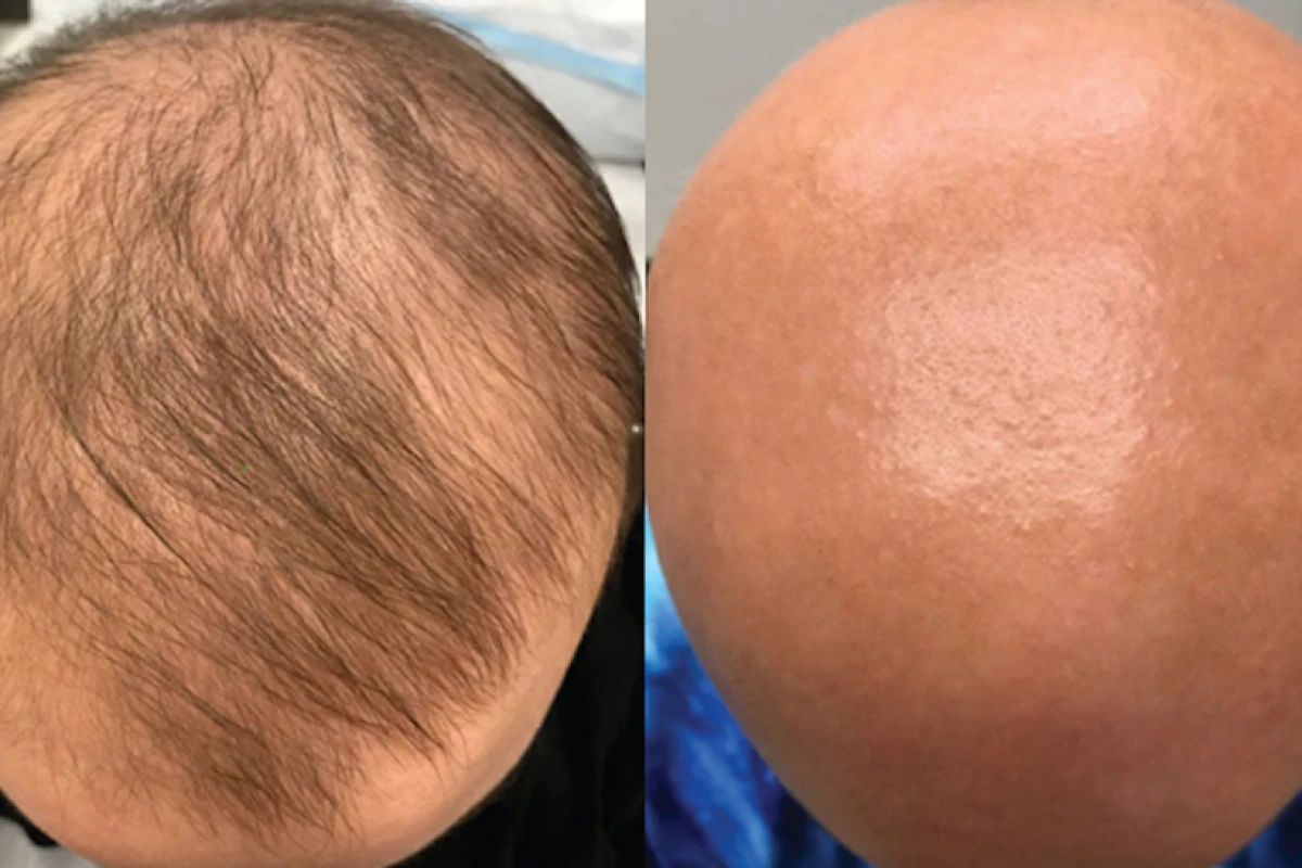 Within weeks of starting the eczema treatment the patient unexpectedly discovered hair growth on her scalp