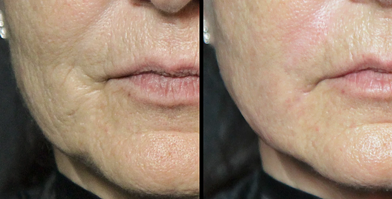 The Botox microdose treatment is claimed to reduce wrinkles without causing the deep facial paralysis commonly associated with Botox