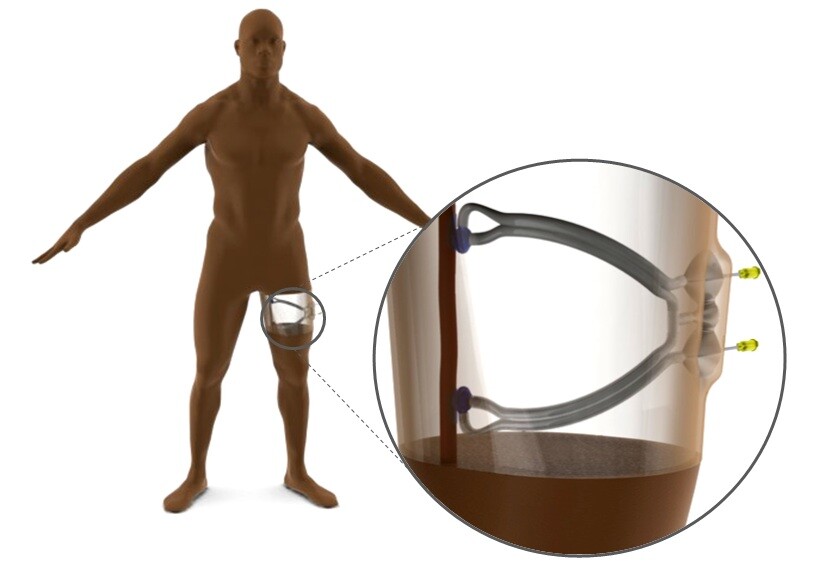 Students from Johns Hopkins University have created an implantable device, that could make dialysis treatments safer and easier (Image: Johns Hopkins University)