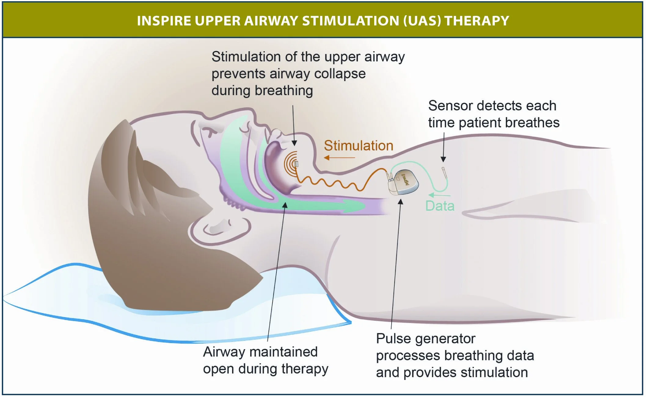 Diagram showing how the Upper Airway Stimulation (UAS) therapy unit works