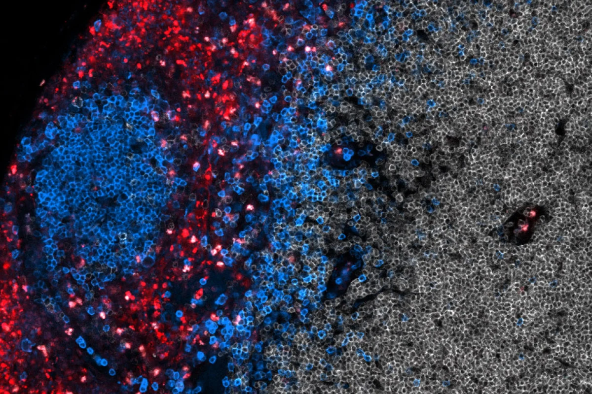 T cells (red) and B cells (blue) in the lymph nodes, after the vaccine CAR-T cell therapy kicks them into overdrive