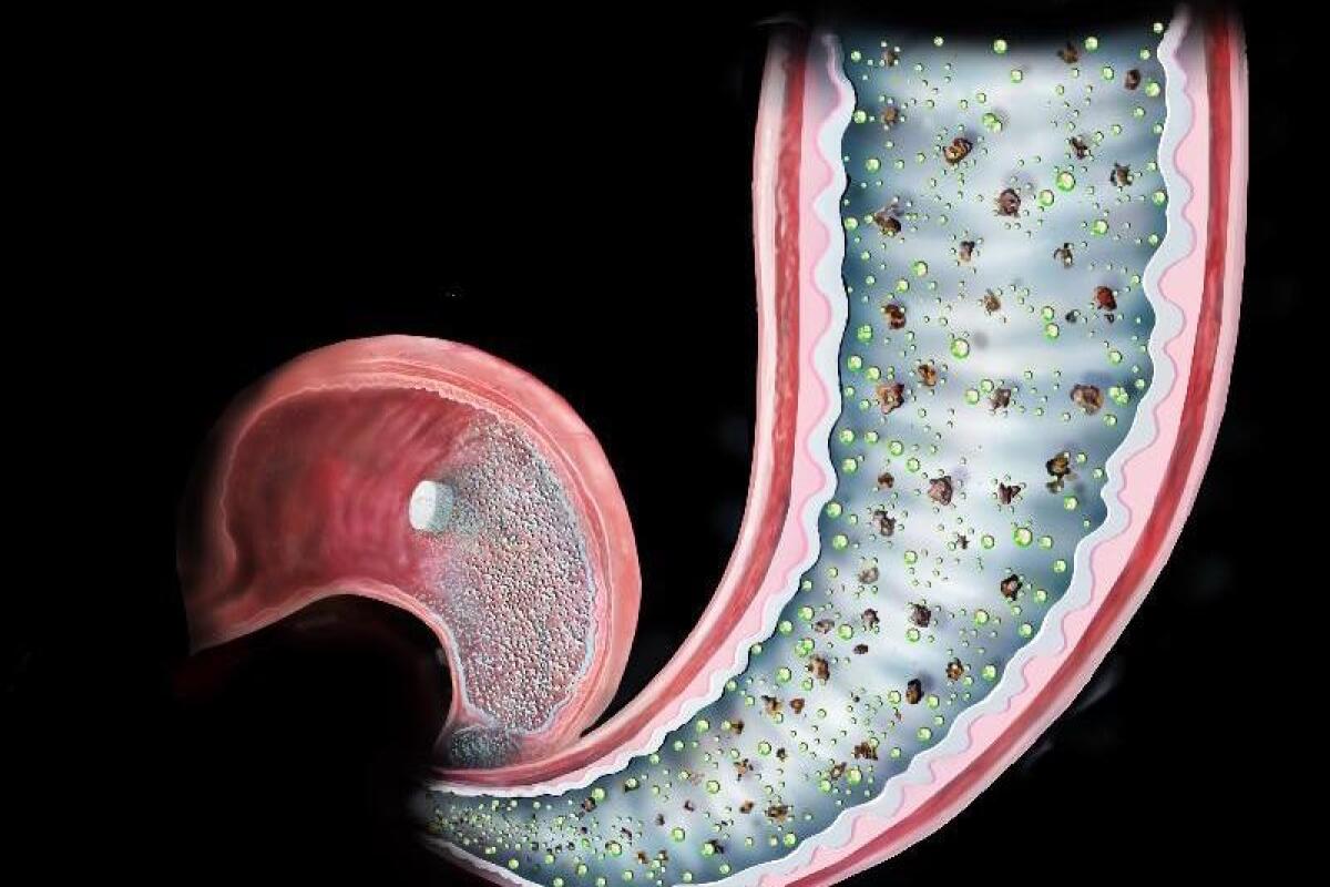 Gastric bypass "surgery in a pill" points to inspired new treatment for