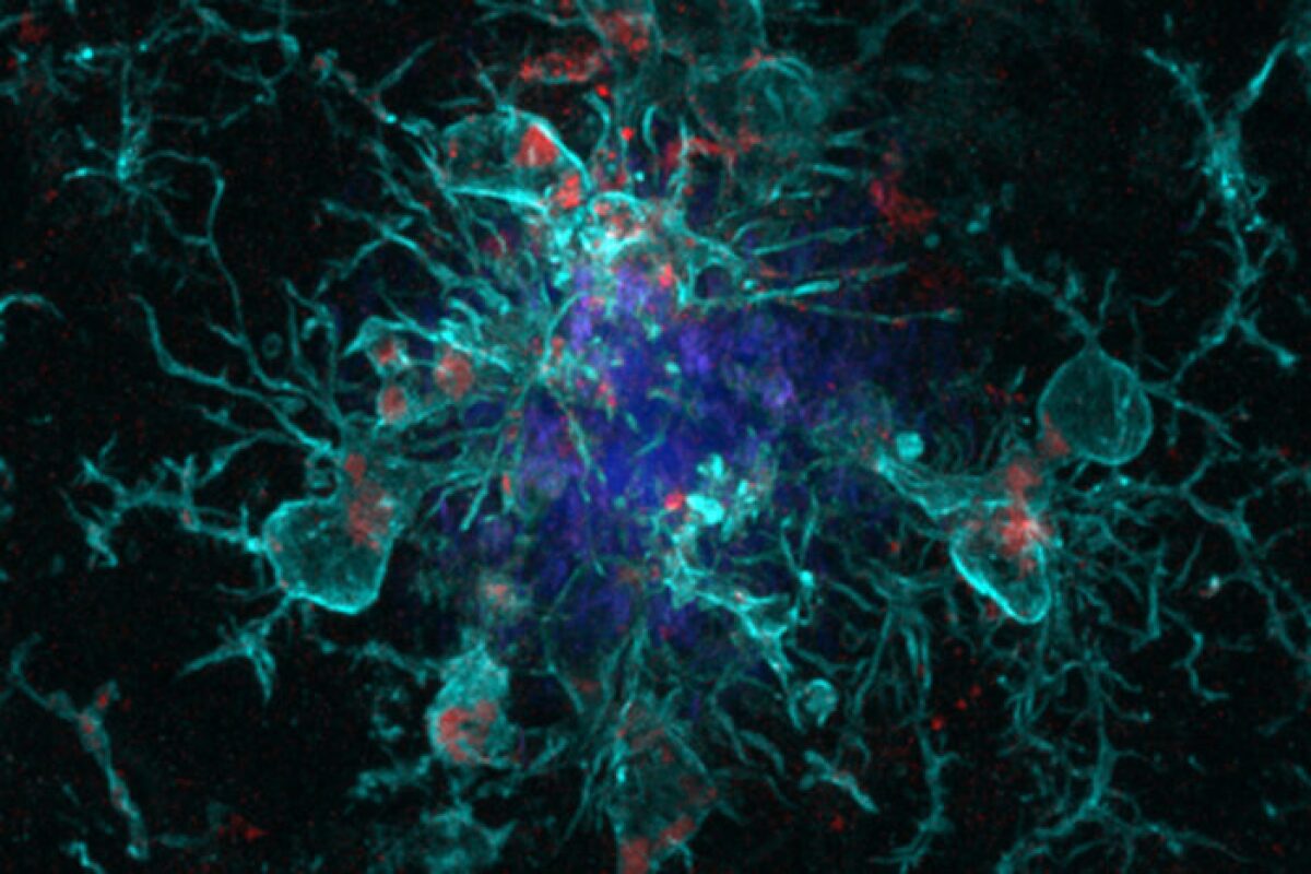 Immune cells known as microglia (turquoise with red dots) surrounding amyloid plaques