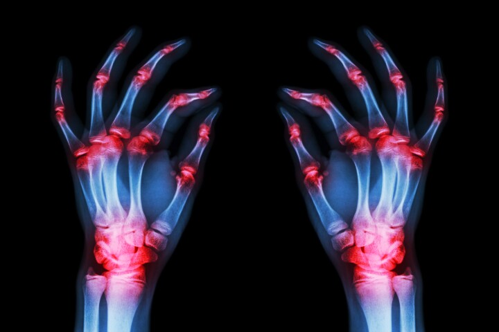 The research is still in preliminary stages but if further validated it could lead to new classes of drugs to treat rheumatoid arthritis
