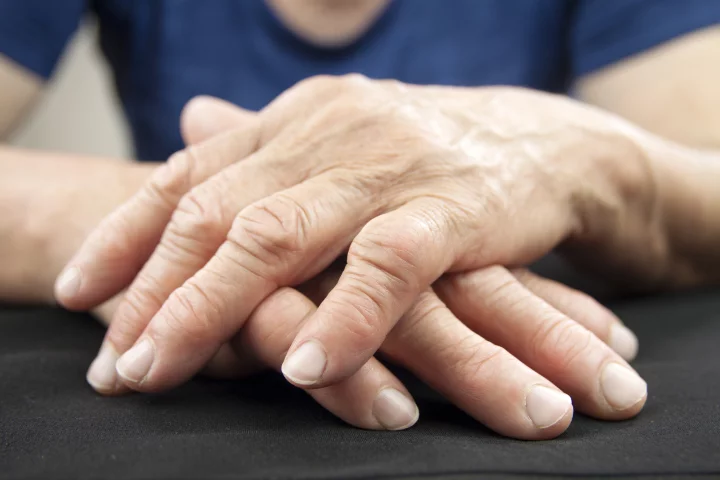Research into arthritis in 2023 has focused on better understanding the disease and improving its treatment