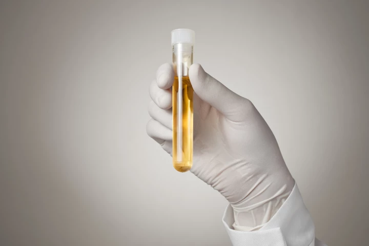 A new study has demonstrated how biomarkers of brain tumors might be detected in urine samples