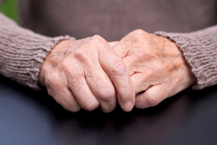 Abatacept has had a significant impact in preventing or delaying the onset of arthritis for those most at risk