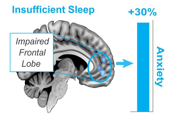 One night of sleep deprivation was found to boost anxiety levels up to 30 percent and inhibit activity in the prefrontal cortex