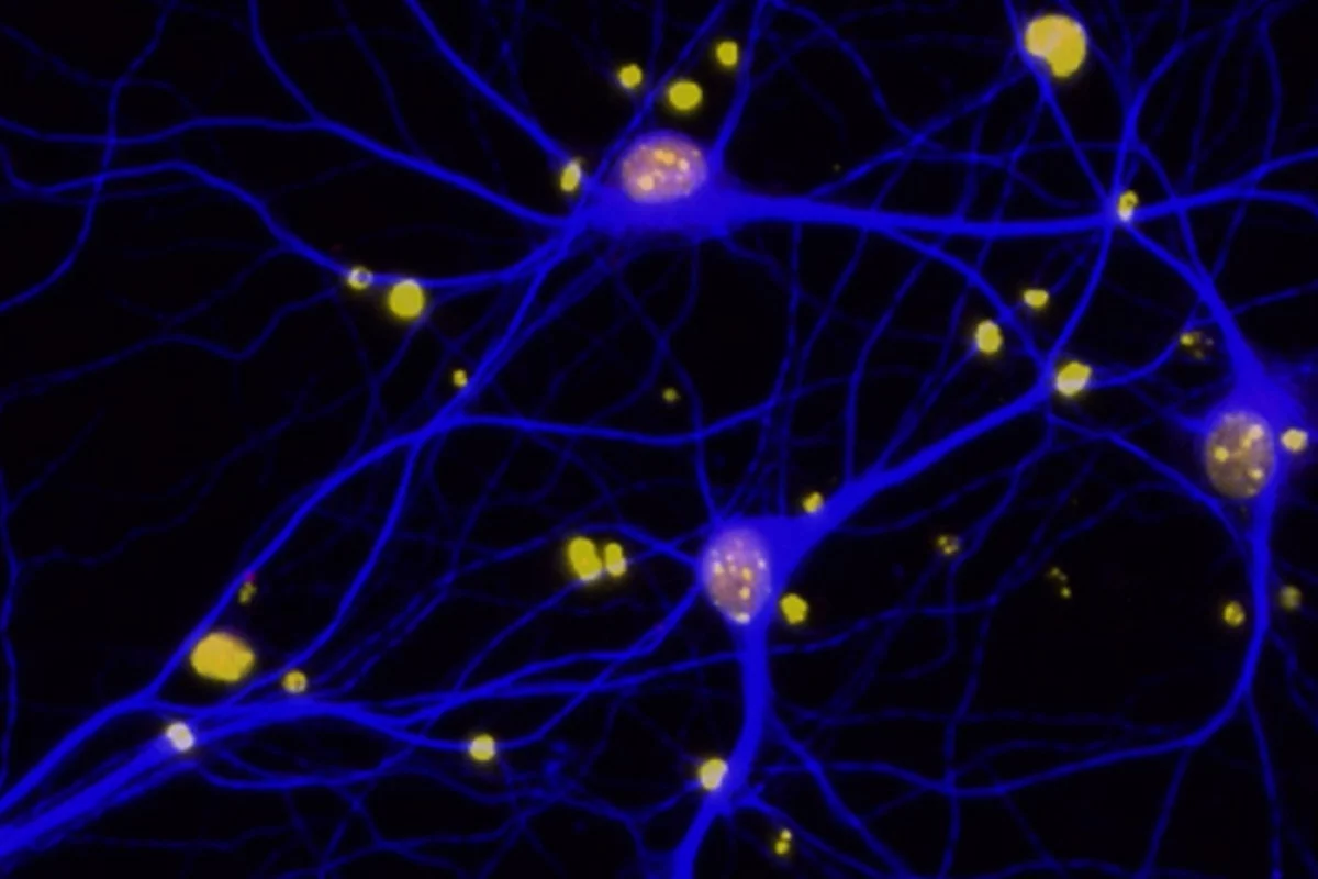 The study found that amyloid-beta plaques in the brain reduce levels on the protein BRCA1 (red) in neurons (blue)