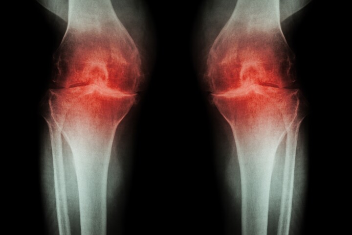 New research has found long-term use of common anti-inflammatory pain relievers did not lead to improvements in inflammatory signs of osteoarthritis