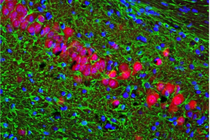 Dying nerve cells (stained pink) in the brain of a mouse with an Alzheimer's-like disease