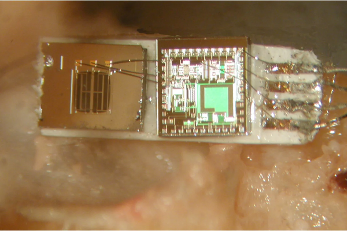 The prototype middle-ear microphone attached to a cadaver’s umbo (Photo: Case Western Reserve University, University of Utah)