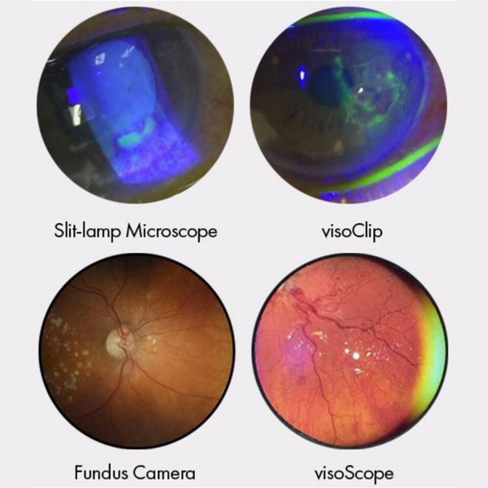 Addons let iPhones perform anterior and retinal eye exams
