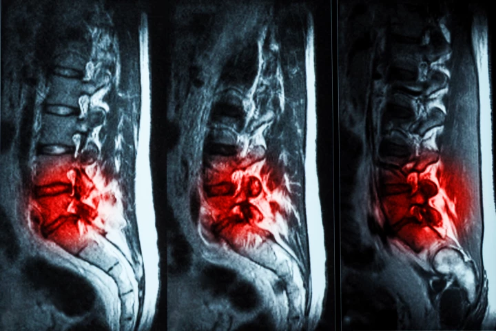 An injectable hydrogel has shown promise in repairing damaged spinal discs in a new human trial